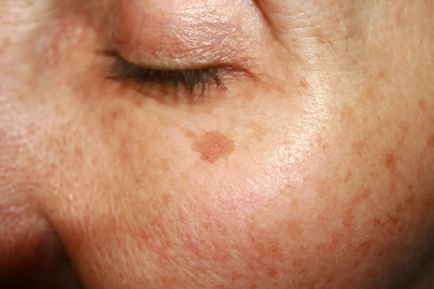 Laser pigmentfjerning